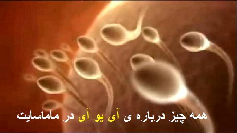 مراقبت های بعد از عمل آی یو آی