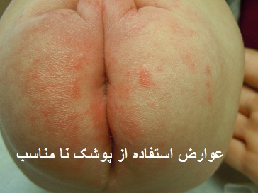 عوارض استفاده از پوشک نامناسب