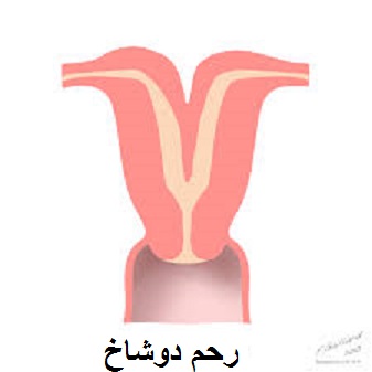رحم 2 شاخ