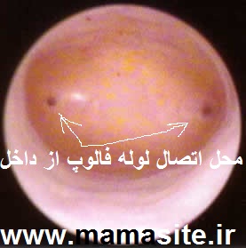 هیستروسکوپی