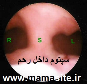 آمادگی های لازم جهت انجام عمل هیستروسکوپی