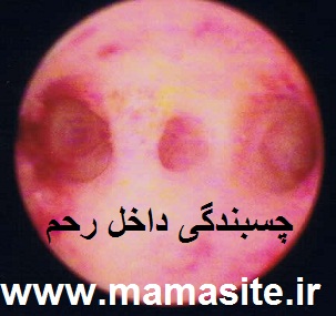 بهترین زمان انجام هیستروسکوپی