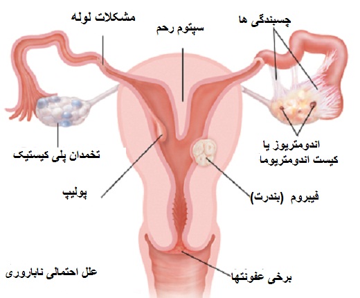 اختلالات لوله های رحمی علت برخی از ناباروری های زنان است