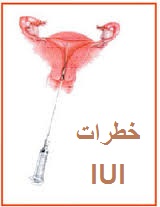 خطراتبارداری به روش  آی یو آی - خطرات IUI