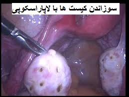 درمان تنبلی تخمدان - سوزاندن کیست ها با لاپراسکوپی