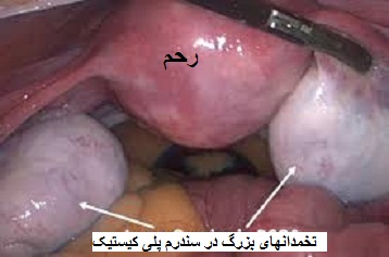 تخمدان پلی کیستیک