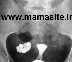 هیستروسالپنگوگرافی
