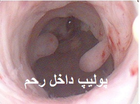 انواع هیستروسکوپی:هیستروسکوپی تشخیصی