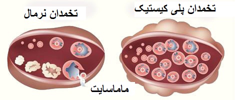 مقایسه تخمدان پلی کیستیک و تخمدان سالم