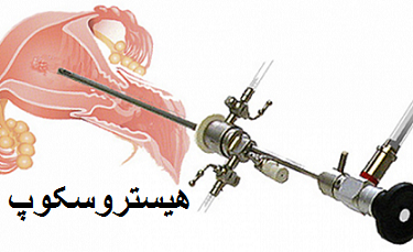 هیستروسکوپ