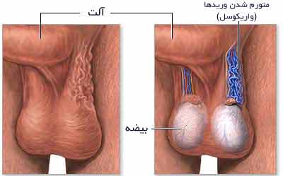 واریکوسل - تشخیص واریکوسل - درمان واریکوسل چگونه است؟