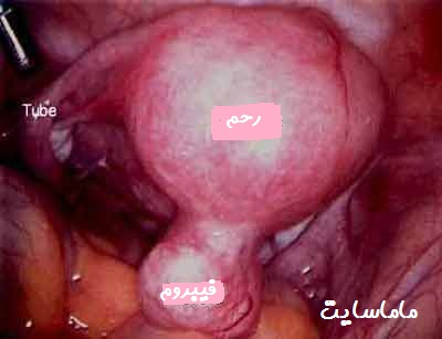 عکس فیبروم رحم ، میوم رحم