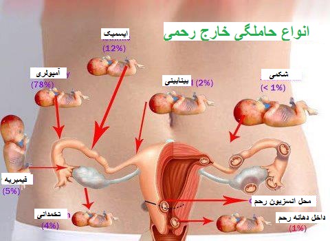انواع حاملگی خارج از رحم