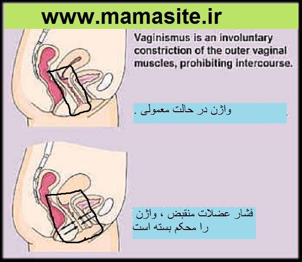 نزدیکی با درد در واژینیسموس