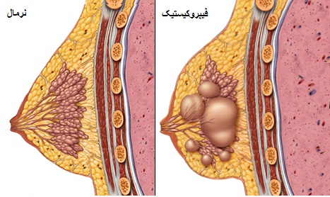 تغییرات فیبروکیستیک پستان