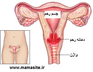 زخم دهانه رحم - دهانه رحم کجاست؟