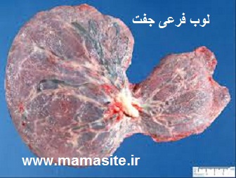 جفت متعدد ( جفت 2 لوبی – جفت چند لوبی ) با یک جنین
