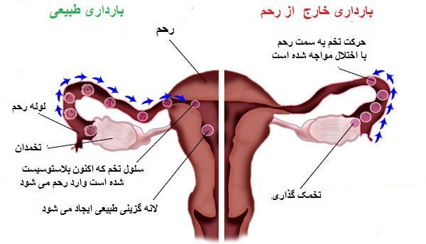 حاملگی خارج از رحم