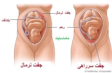 علائم جفت جنین پایین