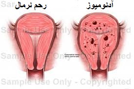 توده آدنومیوز رحم