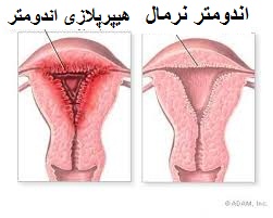 درباره رحم زنان : توده های رحم