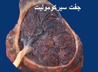 جفت سیرکومولیت