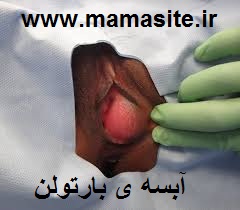 آبسه بارتولن