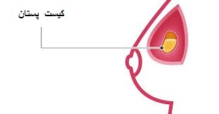 کیست پستان چیست؟ درمان کیست پستان