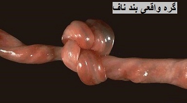 گره بند ناف