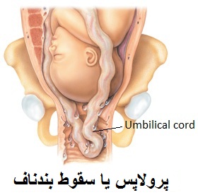 ختلالات بند ناف