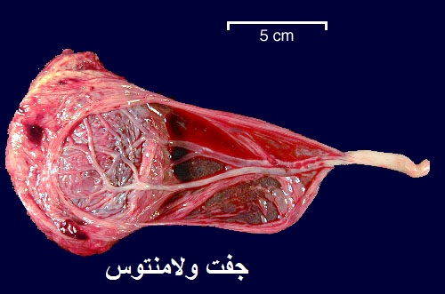 جفت ولامنتوس یا  بادبزنی ( velamentous )