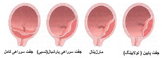 انواع جفت جنین پایین